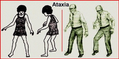 آتاکسی چیست؟,علائم آتاکسی,انواع آتاکسی,درمان آتاکسی,ارثی بودن بیماری آتاکسی