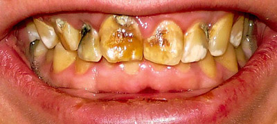 علائم فلوئوروزيس دنداني, جلوگیری از فلوروزیس
