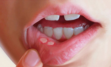 درمان خانگی آفت دهان