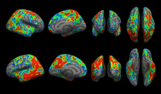 مشاهده میزان از بین رفتن سیناپس‌های مغز در مراحل اولیه آلزایمر